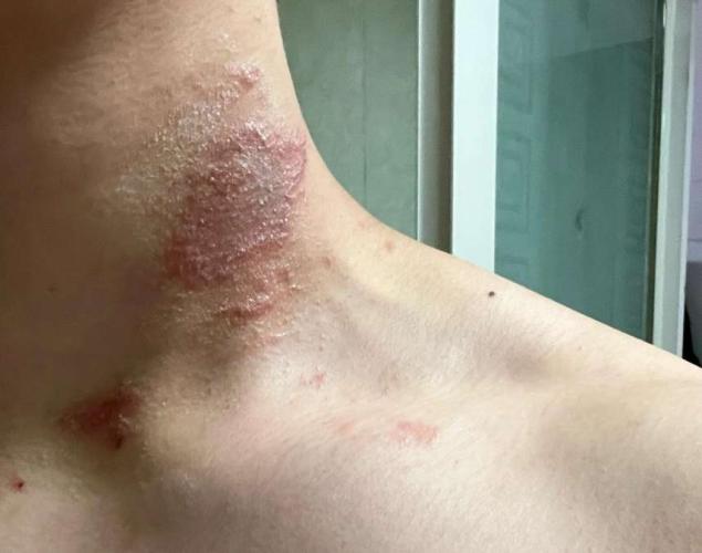 隱 翅 蟲 傷口 處理