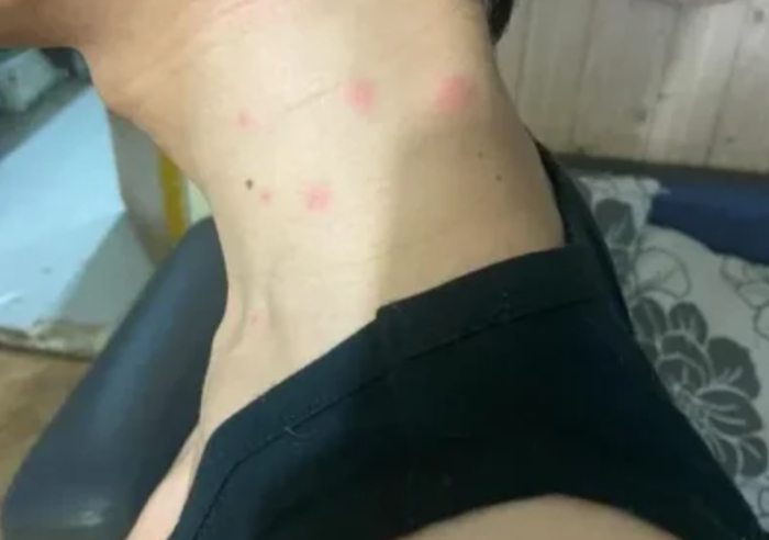 瘙癢 瘙癢