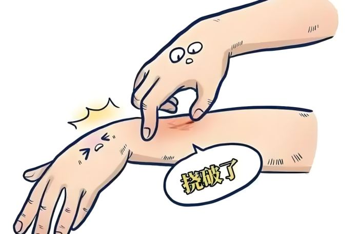 疥蟲傳染途徑 疥蟲傳染途徑