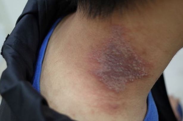 隱翅蟲咬傷症狀治療 隱翅蟲咬傷症狀治療