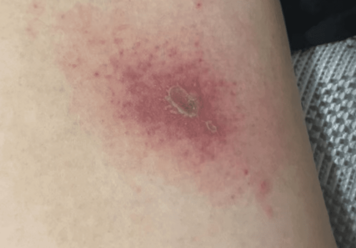 隱翅蟲傷口第一時間沖洗